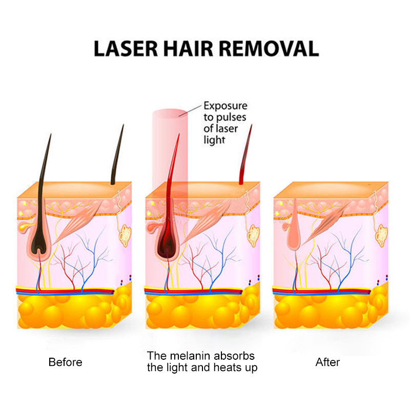 laser hair removal principle