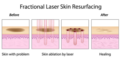 CO2 laser,fractional laser,CO2 fractional laser,Scar removal,skin rejuvenation