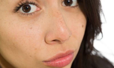 What's the best treatment for acne scars?